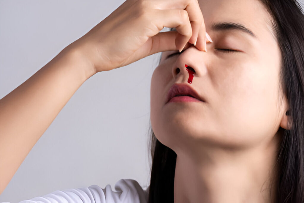 Anterior Nasal Cautery for Epistaxis