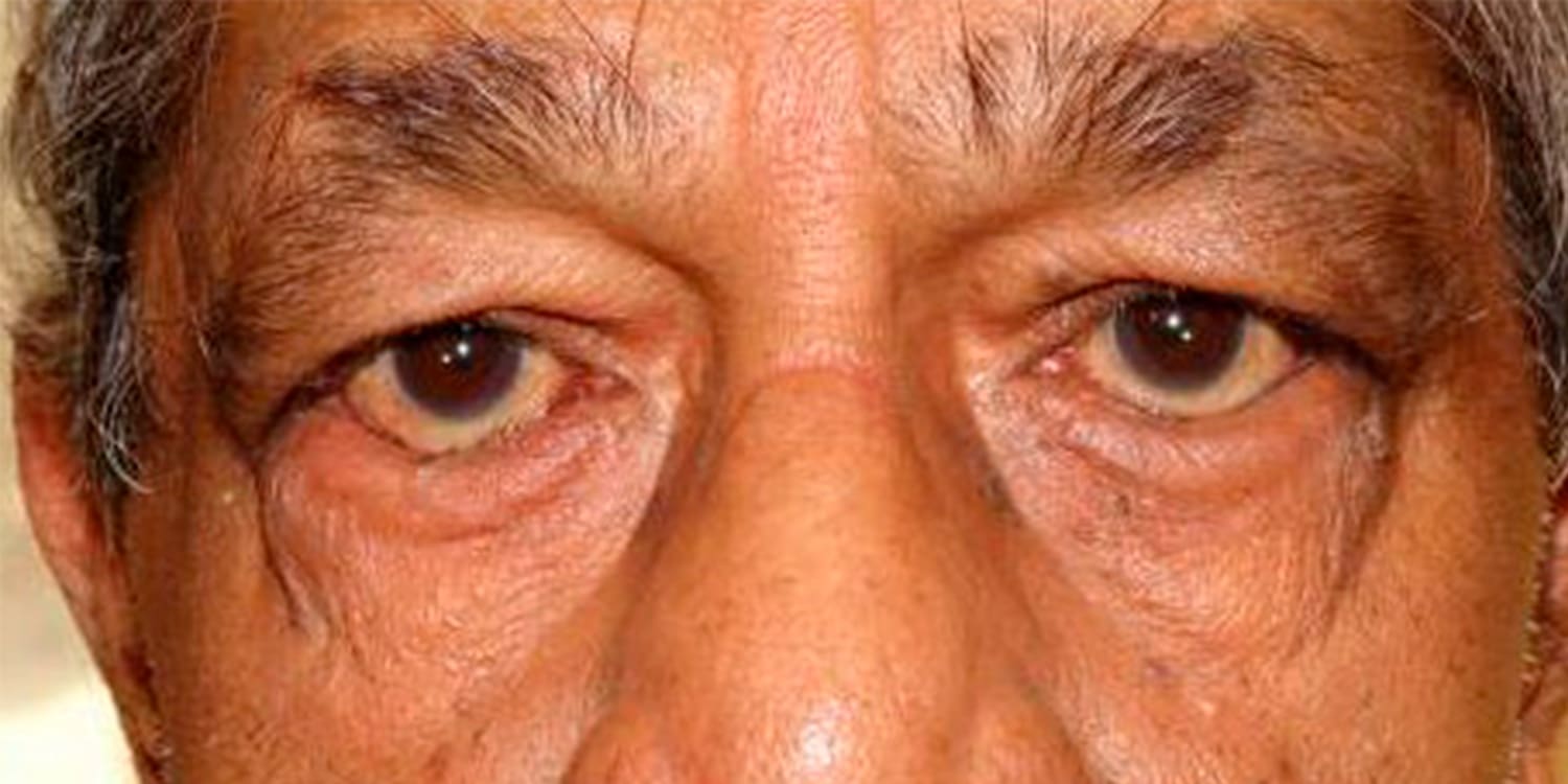 Entropion Ectropion Correction