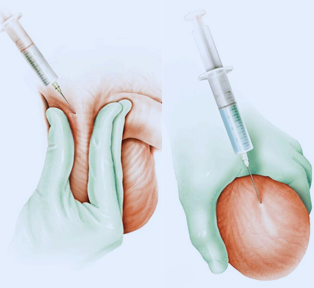 Hydrocele Aspiration