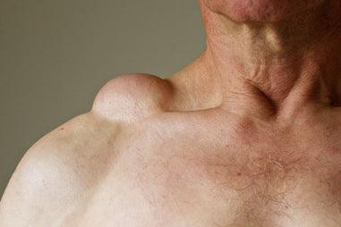 Lipoma