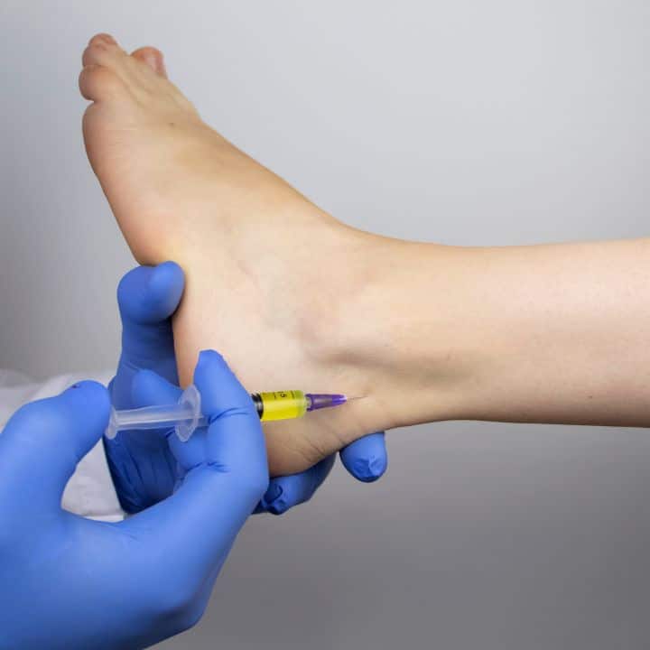 Plantar Fasciitis Injection
