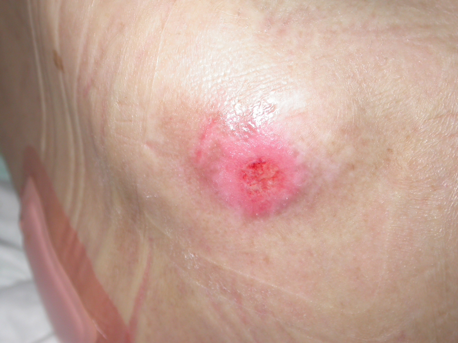 Pressure Sore Treatment