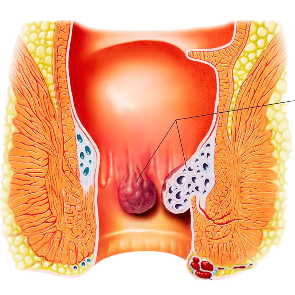 Proctoscopy for Haemorrhoids or Anal Tags
