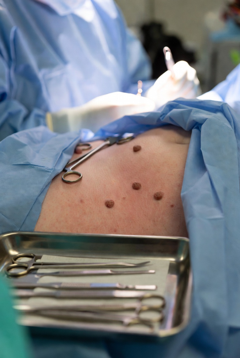 Removal of Genital Skin Tags Warts
