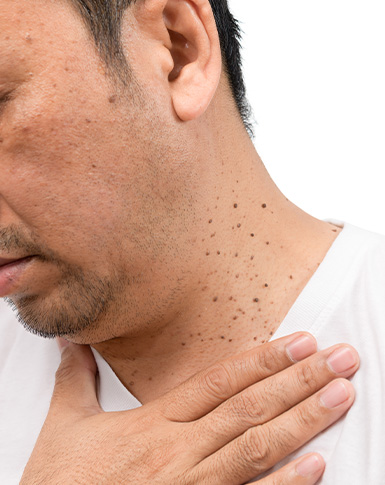 Skin Tag Removal