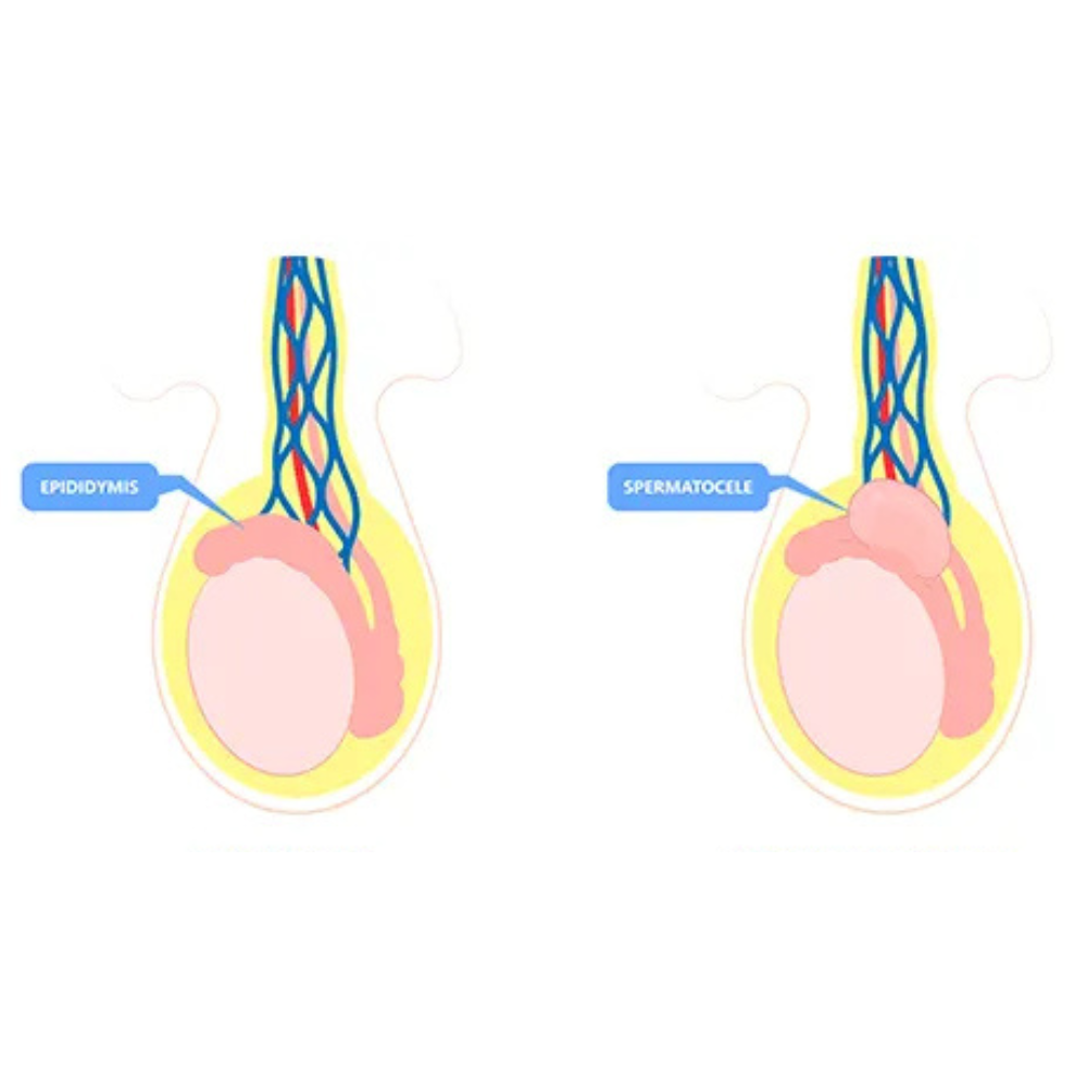 Spermatocele Aspiration
