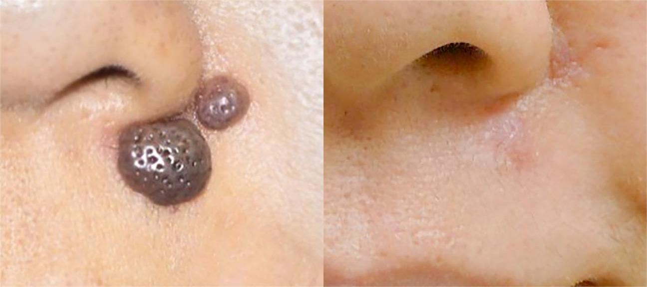 Mole Removal