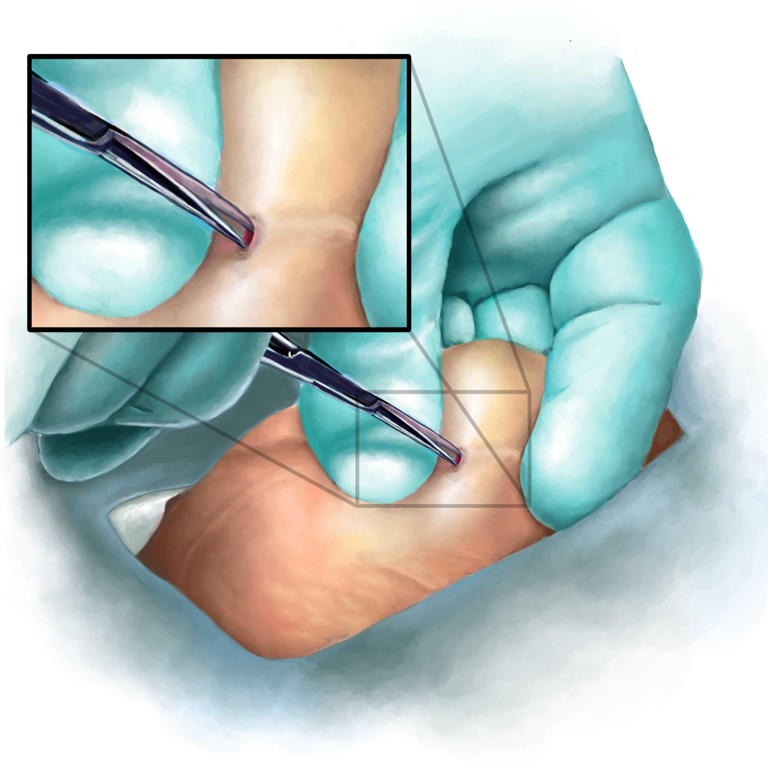 Vasectomy