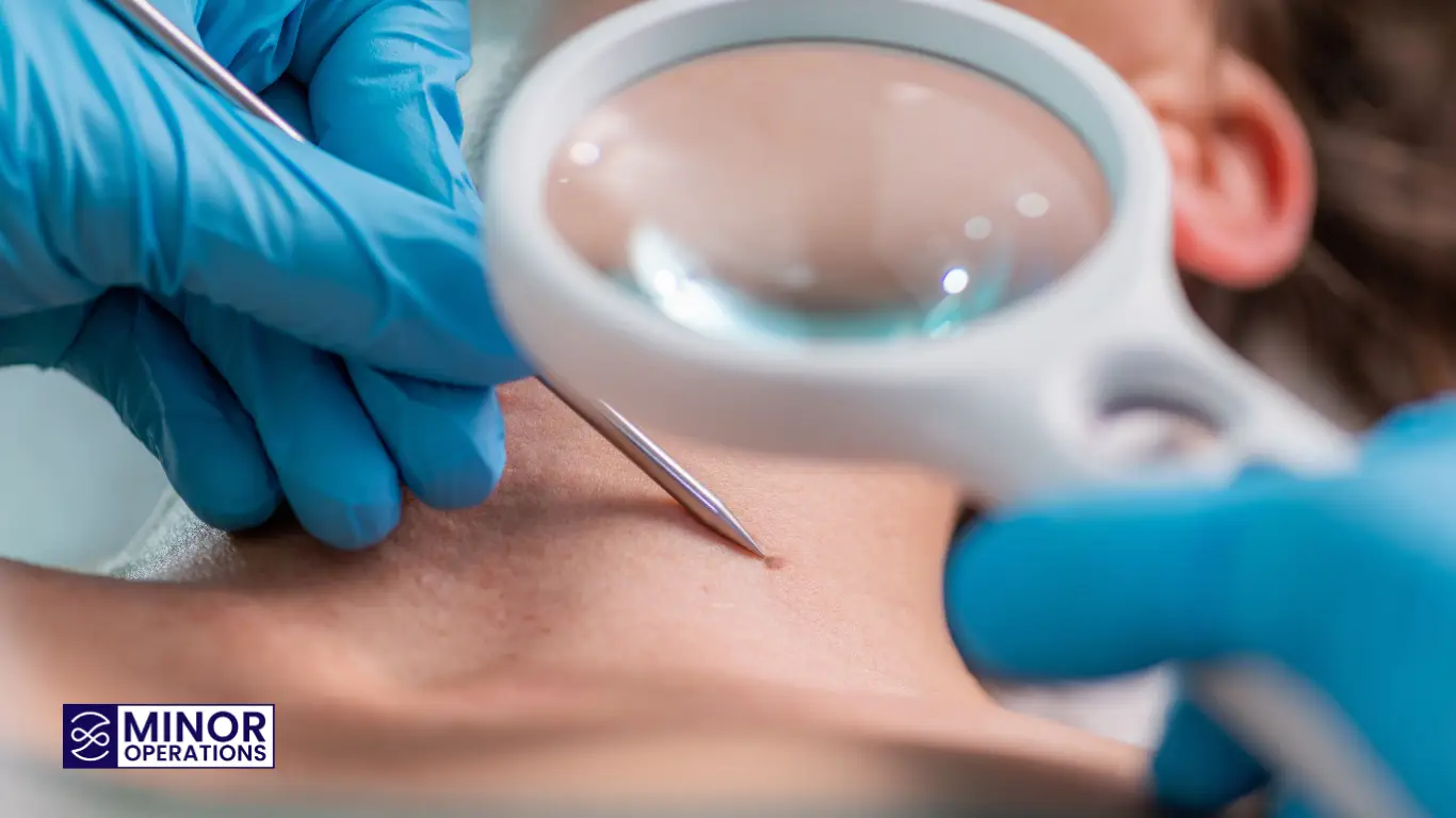 NHS vs Private Skin Tag Removal